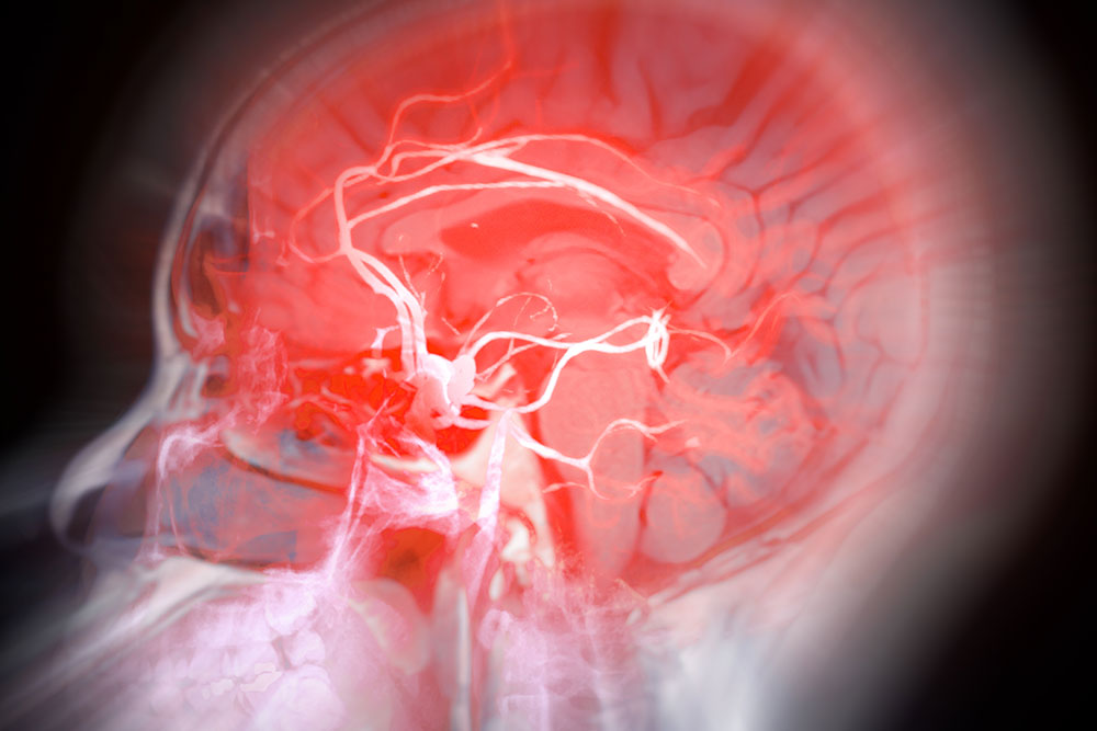 A MRA (Magnetic Resonance Angiography) scan of the brain, providing a detailed view of cerebral blood vessels.